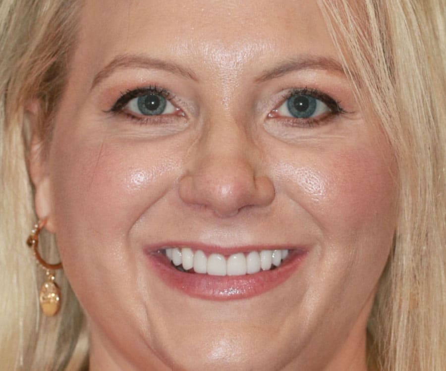 Porcelain Veneers Austin, TX The Cosmetic Dentists of Austin