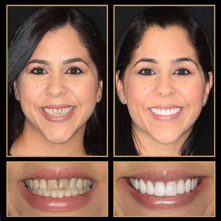 Dental Implants Austin, TX The Cosmetic Dentists of Austin