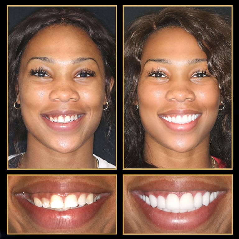 Dental Implants Austin, TX The Cosmetic Dentists of Austin