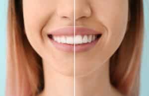 Woman showing her gummy smile and new smile after laser gum contouring in Austin