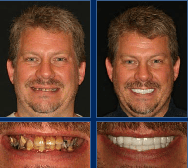 Austin Cosmetic Dentistry Creates Life Changing Smiles