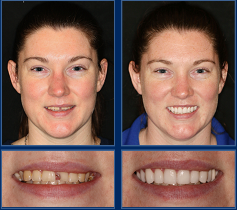 affordable dental implants 1