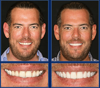 austin 2 visit smile makeover