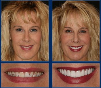 austin cosmetic dentist smile makeover e1458663651624