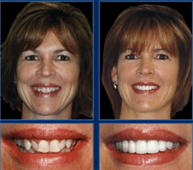 before & after Image of cosmetic orthodontics Austin