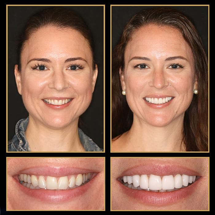 best veneers in austin