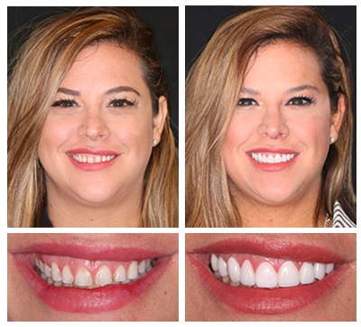 complimentary veneers consultation