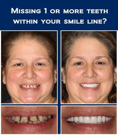 alternatives of dental implants Austin TX