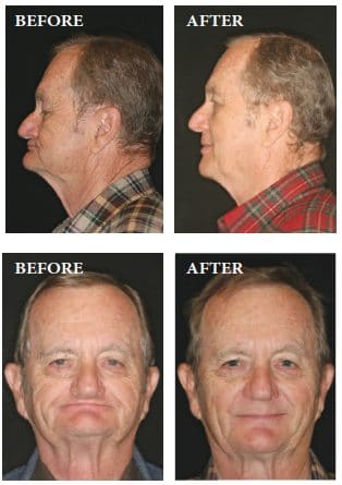 before & after Image of alternatives of dental implants Austin
