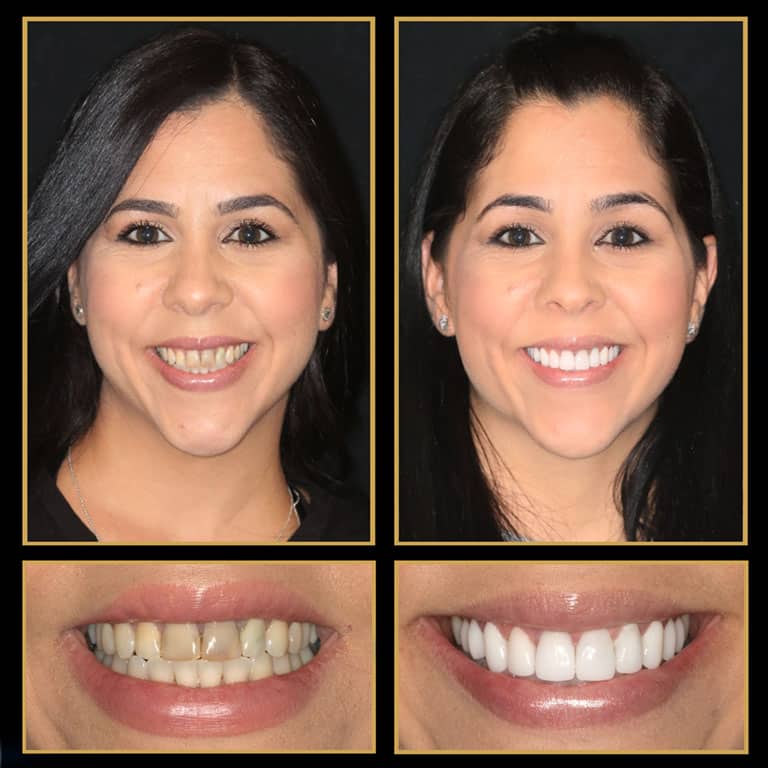 financing your veneers