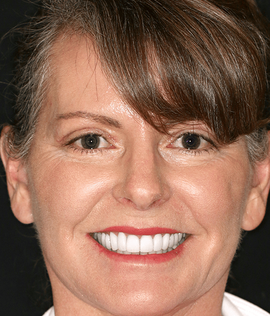 Full Mouth Restoration Austin TX
