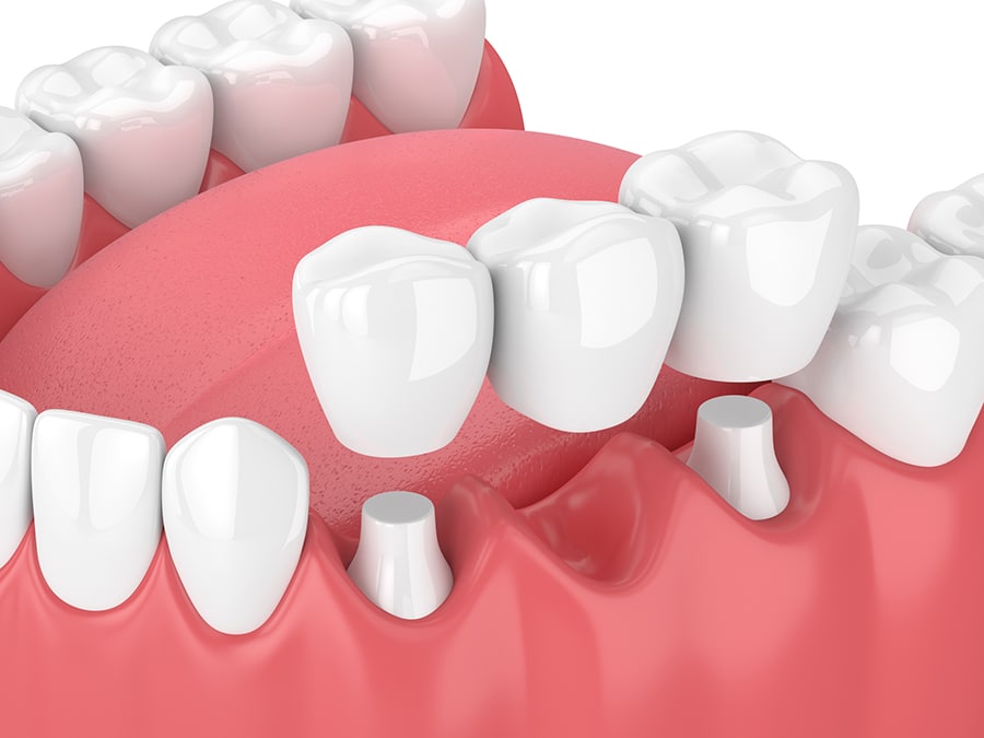 Dental bridges Austin TX