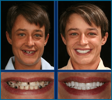 before & after Image of cosmetic orthodontics Austin TX