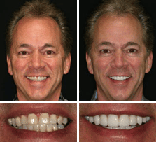 Before & after Image of Veneers Austin TX