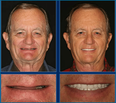 before & after Image of alternatives of dental implants Austin TX