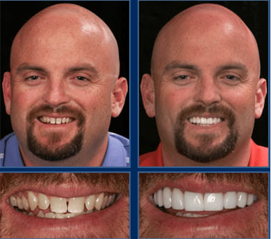 before & after Image of orthodontics Austin TX