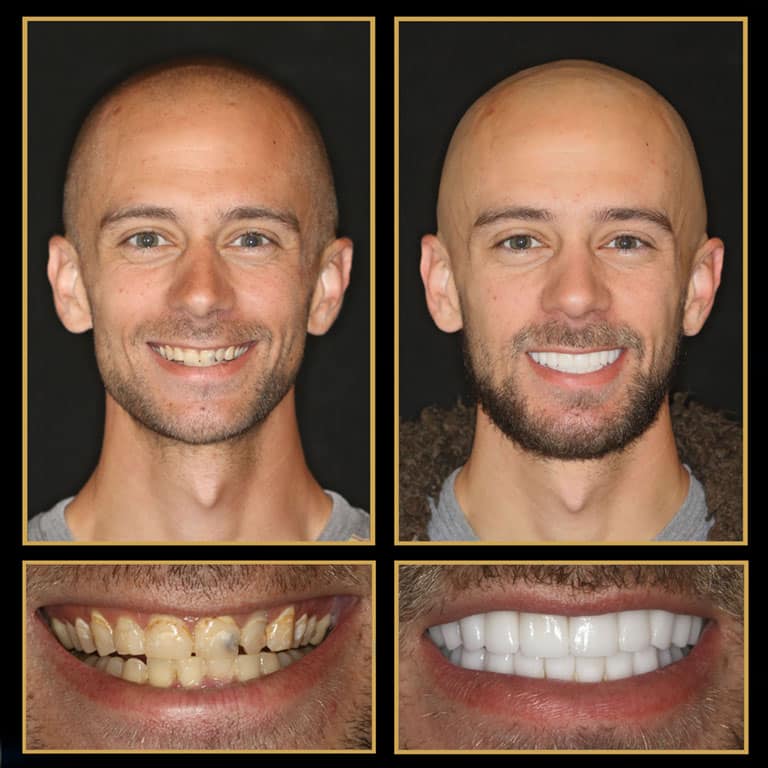 the cosmetic dentists of austin veneers