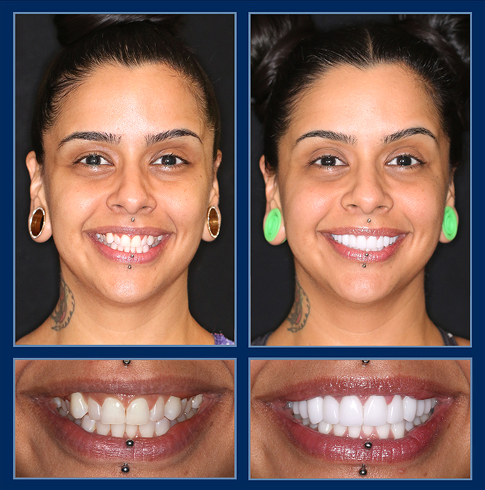 veneers austin