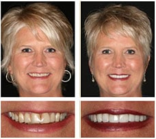 Before & after Image of Porcelain Veneers Austin TX
