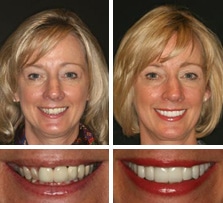 Before & after Image of Dental Veneers Austin TX