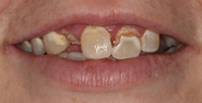 Before Image: Case 100 - front