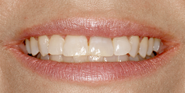 Before Image: Case 101 - front