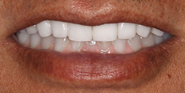 After Image: Case 102 - front