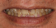 Before Image: Case 102 - front