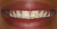 Before Image: Case 103 - front