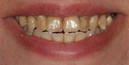 Before Image: Case 105 - front