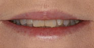 Before Image: Case 106 - front