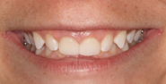 Before Image: Case 107 - front