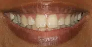 Before Image: Case 108 - front