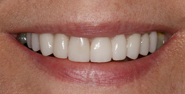 After Image: Case 109 - front