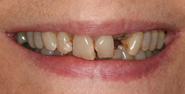 Before Image: Case 109 - front