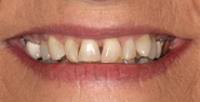 Before Image: Case 110 - front