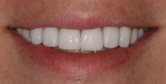 After Image: Case 112 - front