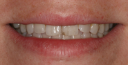 Before Image: Case 112 - front