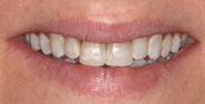Before Image: Case 114 - front