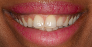 Before Image: Case 117 - front