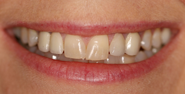 Before Image: Case 118 - front
