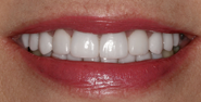 After Image: Case 119 - front