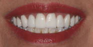 After Image: Case 120 - front