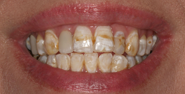 Before Image: Case 120 - front