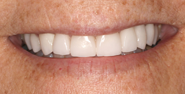 After Image: Case 122 - front