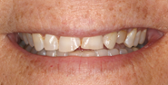 Before Image: Case 122 - front