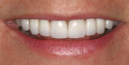 After Image: Case 123 - front