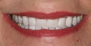 After Image: Case 124 - front