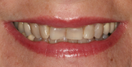 Before Image: Case 124 - front