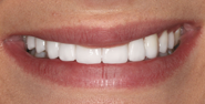 After Image: Case 126 - front